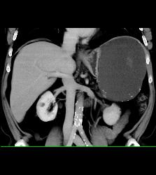 Hemorrhagic Pseudocyst Due to Pancreatitis - CTisus CT Scan