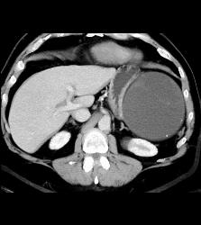 Hemorrhagic Pseudocyst Due to Pancreatitis - CTisus CT Scan