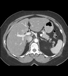 Normal Splenic Vein to Tail of Pancreas - CTisus CT Scan