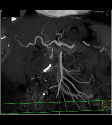 Pseudoaneurysm Off Gastroduodenal Artery (GDA) Is Only Seen on Early Phase Images. Otherwise Seems Like A Mass- See Full Sequence. Patient Also Has Partial Portal Vein Thrombosis - CTisus CT Scan