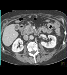 Pseudoaneurysm Off Gastroduodenal Artery (GDA) Is Only Seen on Early Phase Images. Otherwise Seems Like A Mass- See Full Sequence. Patient Also Has Partial Portal Vein Thrombosis - CTisus CT Scan