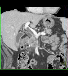 Pseudoaneurysm Off Gastroduodenal Artery (GDA) Is Only Seen on Early Phase Images. Otherwise Seems Like A Mass- See Full Sequence. Patient Also Has Partial Portal Vein Thrombosis - CTisus CT Scan