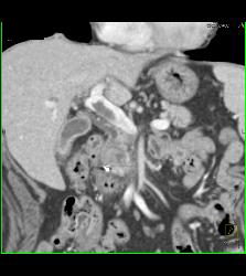 Pseudoaneurysm Off Gastroduodenal Artery (GDA) Is Only Seen on Early Phase Images. Otherwise Seems Like A Mass- See Full Sequence. Patient Also Has Partial Portal Vein Thrombosis - CTisus CT Scan