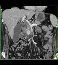 Pseudoaneurysm Off Gastroduodenal Artery (GDA) Is Only Seen on Early Phase Images. Otherwise Seems Like A Mass- See Full Sequence. Patient Also Has Partial Portal Vein Thrombosis - CTisus CT Scan