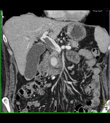 Pseudoaneurysm Off Gastroduodenal Artery (GDA) Is Only Seen on Early Phase Images. Otherwise Seems Like A Mass- See Full Sequence. Patient Also Has Partial Portal Vein Thrombosis - CTisus CT Scan