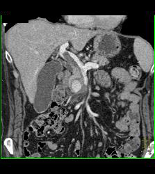 Pseudoaneurysm Off Gastroduodenal Artery (GDA) Is Only Seen on Early Phase Images. Otherwise Seems Like A Mass- See Full Sequence. Patient Also Has Partial Portal Vein Thrombosis - CTisus CT Scan