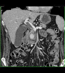 Pseudoaneurysm Off Gastroduodenal Artery (GDA) Is Only Seen on Early Phase Images. Otherwise Seems Like A Mass- See Full Sequence. Patient Also Has Partial Portal Vein Thrombosis - CTisus CT Scan