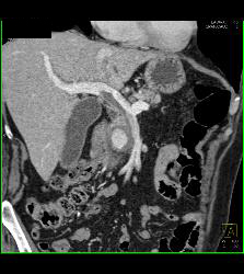 Pseudoaneurysm Off Gastroduodenal Artery (GDA) Is Only Seen on Early Phase Images. Otherwise Seems Like A Mass- See Full Sequence. Patient Also Has Partial Portal Vein Thrombosis - CTisus CT Scan