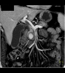 Pseudoaneurysm Off Gastroduodenal Artery (GDA) Is Only Seen on Early Phase Images. Otherwise Seems Like A Mass- See Full Sequence. Patient Also Has Partial Portal Vein Thrombosis - CTisus CT Scan