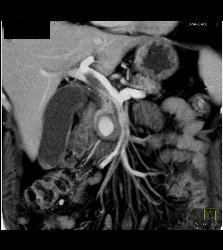 Pseudoaneurysm Off Gastroduodenal Artery (GDA) Is Only Seen on Early Phase Images. Otherwise Seems Like A Mass- See Full Sequence. Patient Also Has Partial Portal Vein Thrombosis - CTisus CT Scan