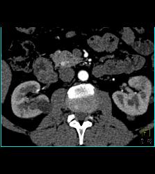 5mm Islet Cell Tumor - CTisus CT Scan