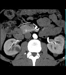 5mm Islet Cell Tumor - CTisus CT Scan