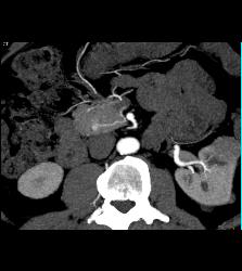 5mm Islet Cell Tumor - CTisus CT Scan