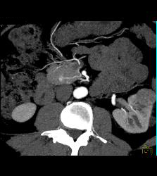 5mm Islet Cell Tumor - CTisus CT Scan