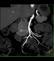 5mm Islet Cell Tumor - CTisus CT Scan