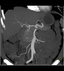 5mm Islet Cell Tumor - CTisus CT Scan