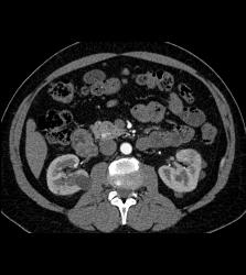 5mm Islet Cell Tumor - CTisus CT Scan