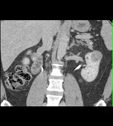 Ampullary Carcinoma S/p Endoscopic Retrograde Cholangiopancreatography (ERCP) - CTisus CT Scan