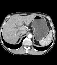 Ampullary Carcinoma S/p Endoscopic Retrograde Cholangiopancreatography (ERCP) - CTisus CT Scan