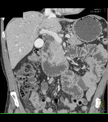 Ampullary Carcinoma S/p Endoscopic Retrograde Cholangiopancreatography (ERCP) - CTisus CT Scan