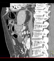 Intraductal Papillary Mucinous Neoplasm (IPMN) - See Full Sequence - CTisus CT Scan