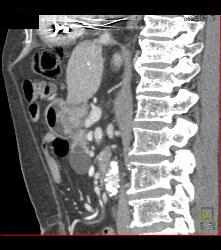 Intraductal Papillary Mucinous Neoplasm (IPMN) - See Full Sequence - CTisus CT Scan