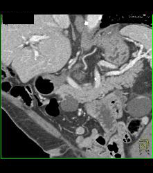 Intraductal Papillary Mucinous Neoplasm (IPMN) - See Full Sequence - CTisus CT Scan