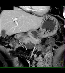 Intraductal Papillary Mucinous Neoplasm (IPMN) - See Full Sequence - CTisus CT Scan