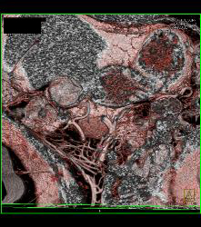 Intraductal Papillary Mucinous Neoplasm (IPMN) - See Full Sequence - CTisus CT Scan