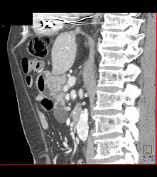 Intraductal Papillary Mucinous Neoplasm (IPMN) - See Full Sequence - CTisus CT Scan