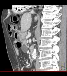 Intraductal Papillary Mucinous Neoplasm (IPMN) - See Full Sequence - CTisus CT Scan