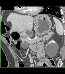 Intraductal Papillary Mucinous Neoplasm (IPMN) - See Full Sequence - CTisus CT Scan