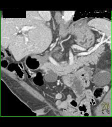 Intraductal Papillary Mucinous Neoplasm (IPMN) - See Full Sequence - CTisus CT Scan