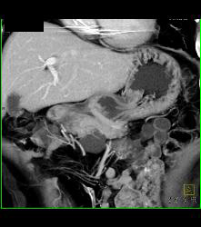 Intraductal Papillary Mucinous Neoplasm (IPMN) - See Full Sequence - CTisus CT Scan