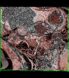 Intraductal Papillary Mucinous Neoplasm (IPMN) - See Full Sequence - CTisus CT Scan