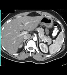 1 Cm Splenic Artery Aneurysm Simulates A Pancreatic Islet Cell Tumor - CTisus CT Scan