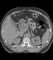 Cystadenoma - CTisus CT Scan