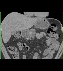 Cystadenoma - CTisus CT Scan