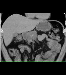 Cystadenoma - CTisus CT Scan