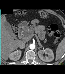 Cystadenoma - CTisus CT Scan