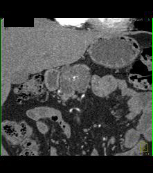 Cystadenoma - CTisus CT Scan