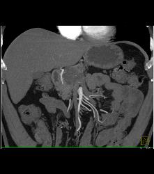 Cystadenoma - CTisus CT Scan