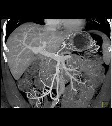 Cystadenoma - CTisus CT Scan