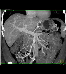 Cystadenoma - CTisus CT Scan