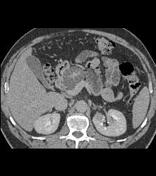 Cystadenoma - CTisus CT Scan