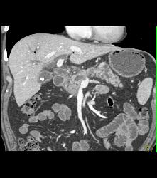 Pancreatic Cancer Encases the Portal Vein (PV) Without Occlusion. Pancreatic Cancer Arose in A Intraductal Papillary Mucinous Neoplasm (IPMN). See IPMNs in the Rest of the Gland - CTisus CT Scan