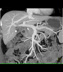 Pancreatic Cancer Encases the Portal Vein (PV) Without Occlusion. Pancreatic Cancer Arose in A Intraductal Papillary Mucinous Neoplasm (IPMN). See IPMNs in the Rest of the Gland - CTisus CT Scan