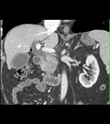 Pancreatic Cancer Encases the Portal Vein (PV) Without Occlusion. Pancreatic Cancer Arose in A Intraductal Papillary Mucinous Neoplasm (IPMN). See IPMNs in the Rest of the Gland - CTisus CT Scan