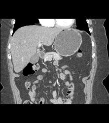 Atrophic Pancreas Without Mass - CTisus CT Scan