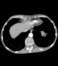 Neuroendocrine Tumor of the Pancreas Involves the Left Kidney - CTisus CT Scan